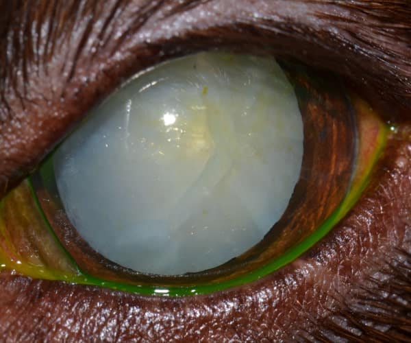 Cataract eye